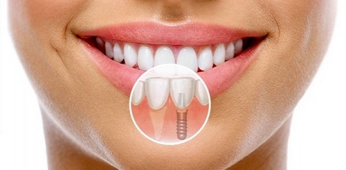 Одномоментная имплантация зубов: плюсы метода
